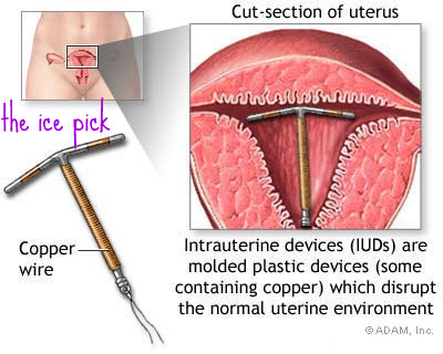 I'm NOT putting an ice pick into my uterus